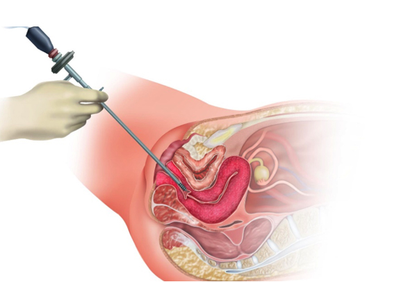 Hysteroscopy