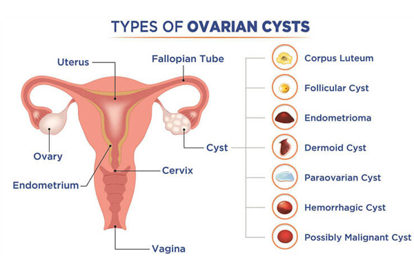 Ovarian Cyst